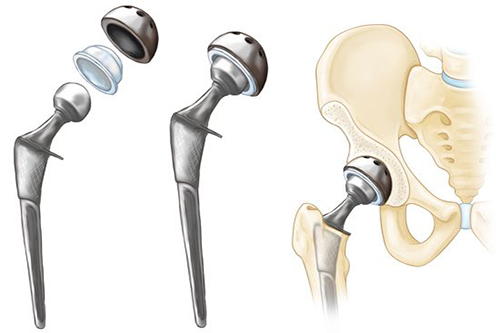 Joint replacement implant components of the kind revised in complex revision surgery